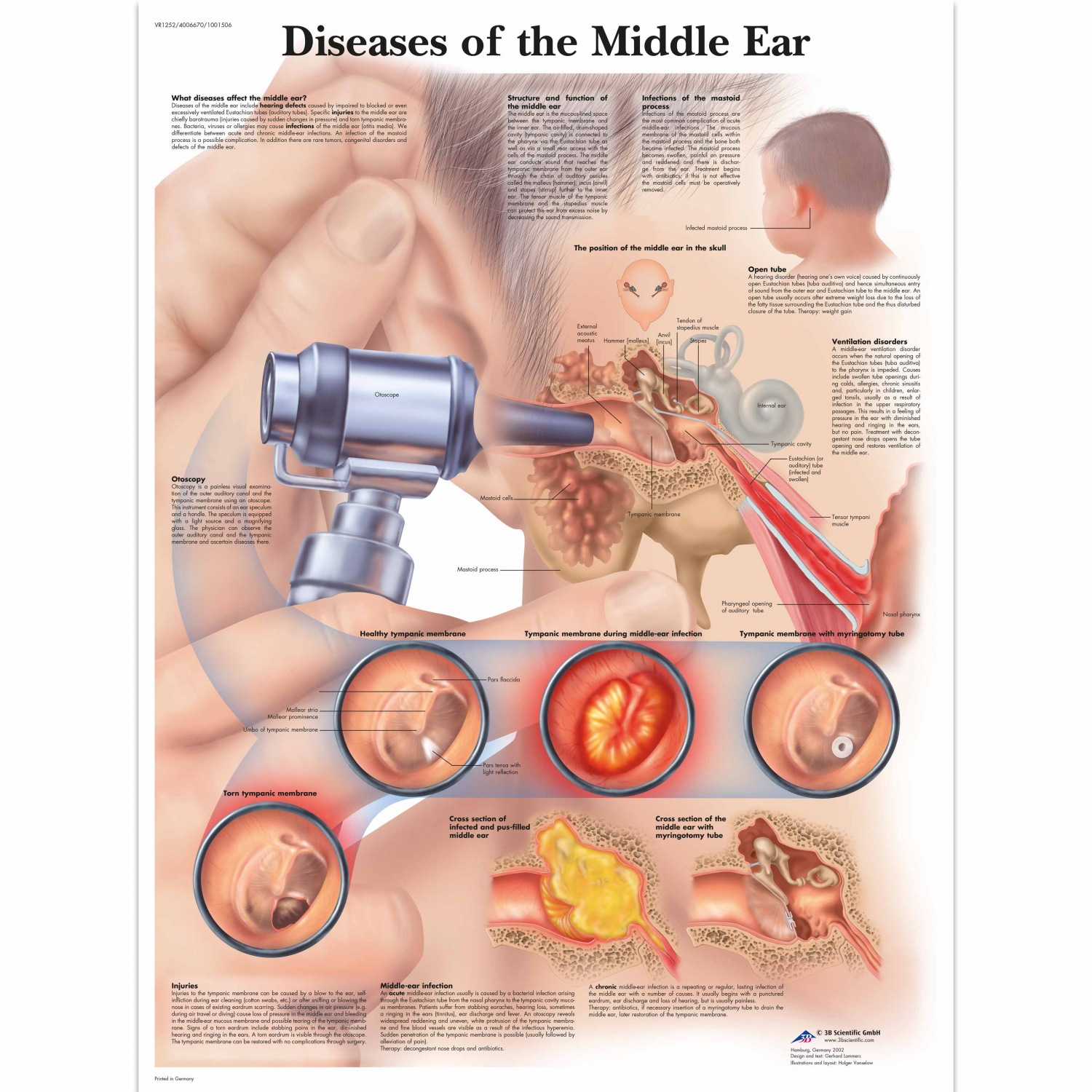 Wandplaat geplastificeerd Diseases of the Middle Ear - 50 x 67 cm