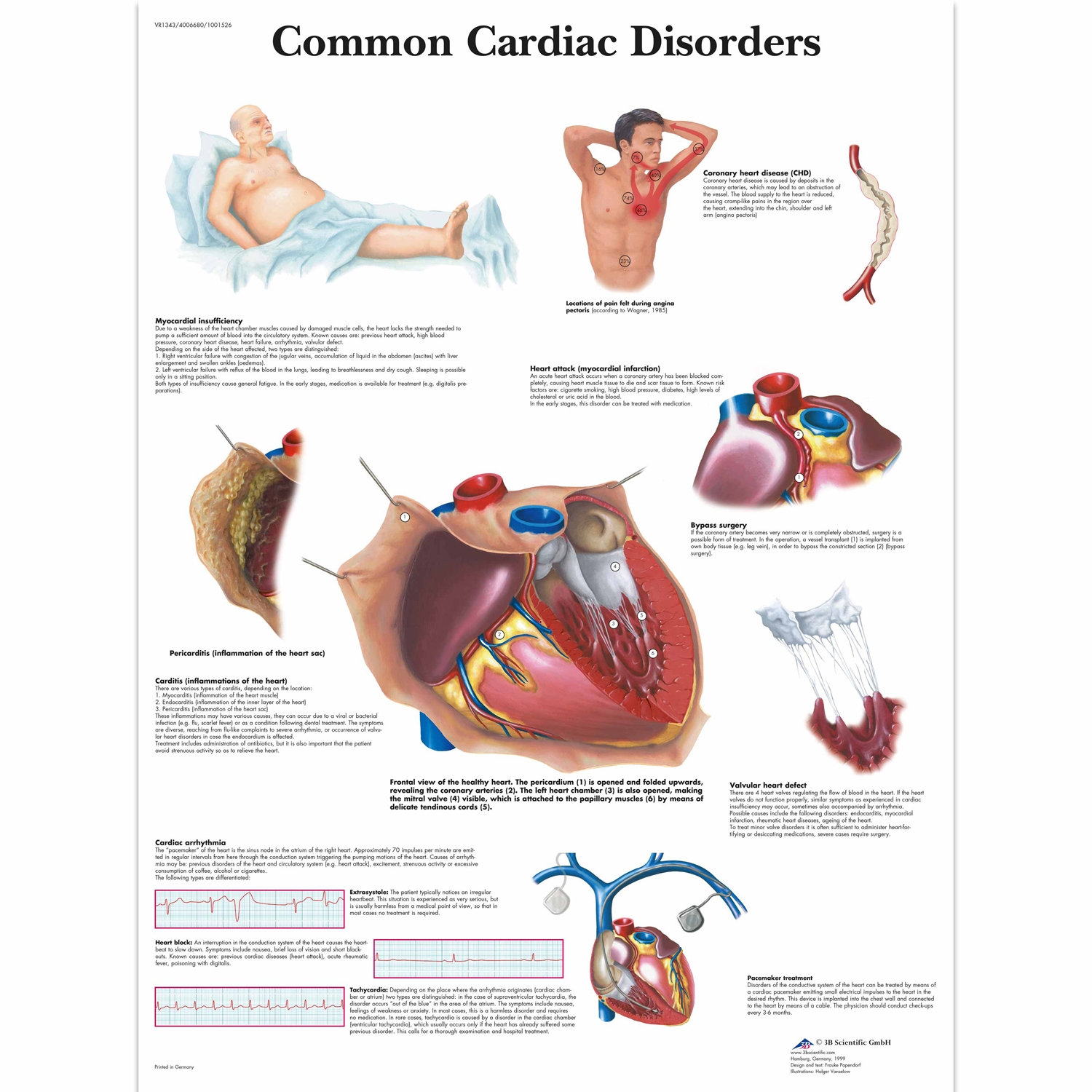 Wandplaat geplastificeerd Common Cardiac Disorders - 50 x 67 cm