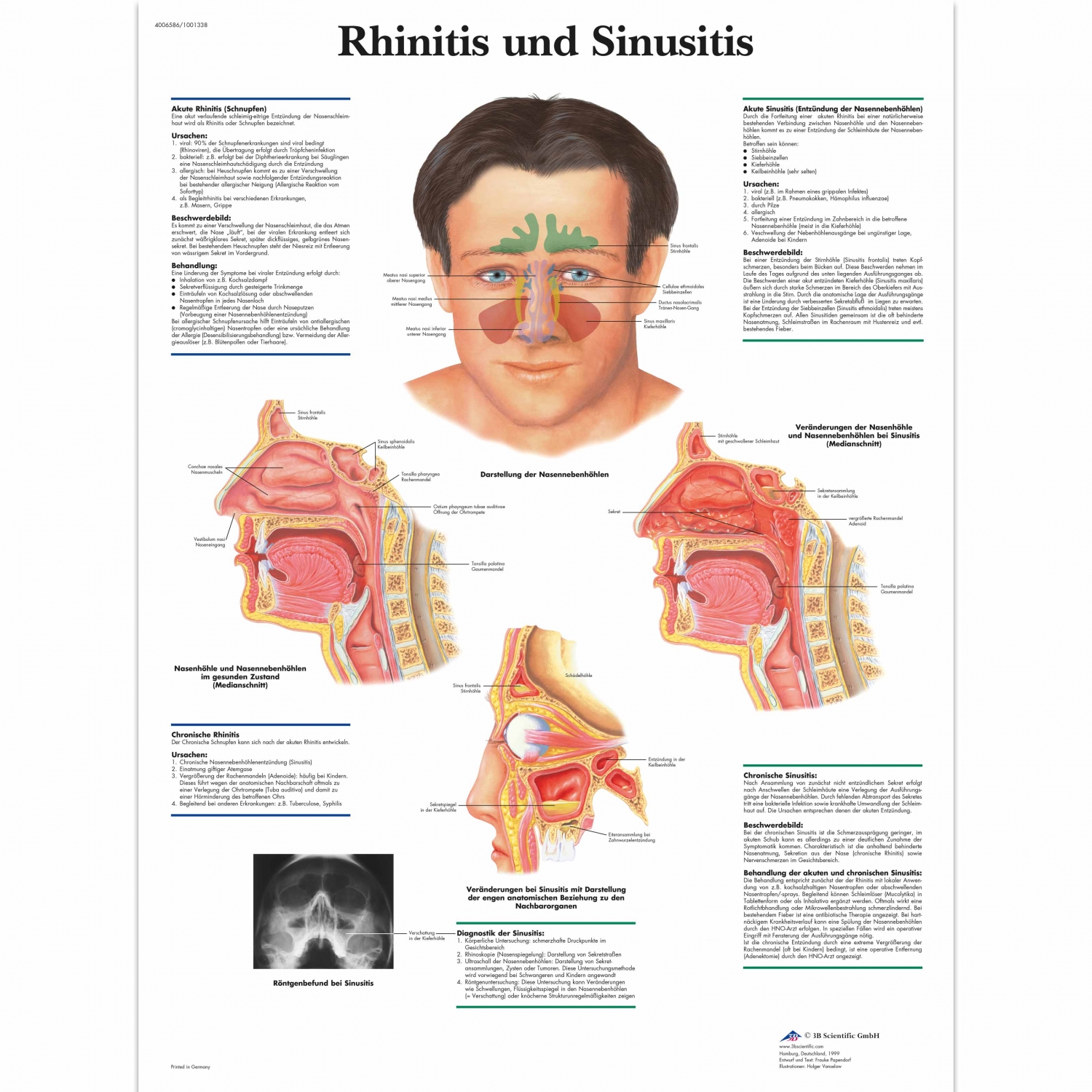 Wandplaat geplastificeerd Rhinitis and Sinusitis - 50 x 67 cm